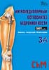 Charfix system - Интрамедуллярный остеосинтез бедренной кости. Имплантаты, инструментарий, методика операций - 2004 год